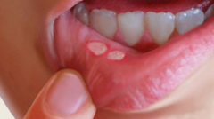 5个小妙招巧治口腔溃疡，在嘴里含几块冰糖有一定疗效