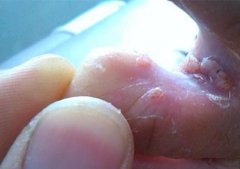 尖疣图片女性的早期症状，通过性接触/间接接触/母婴传播