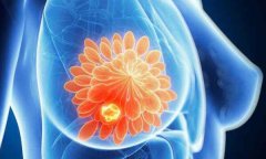 乳腺癌已成为全球第一大癌症，已经取代肺癌