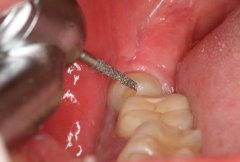 智齿拔牙后窟窿恢复图，3个月时间可完全愈合（4个过程）